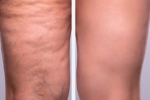 cellulite before and after